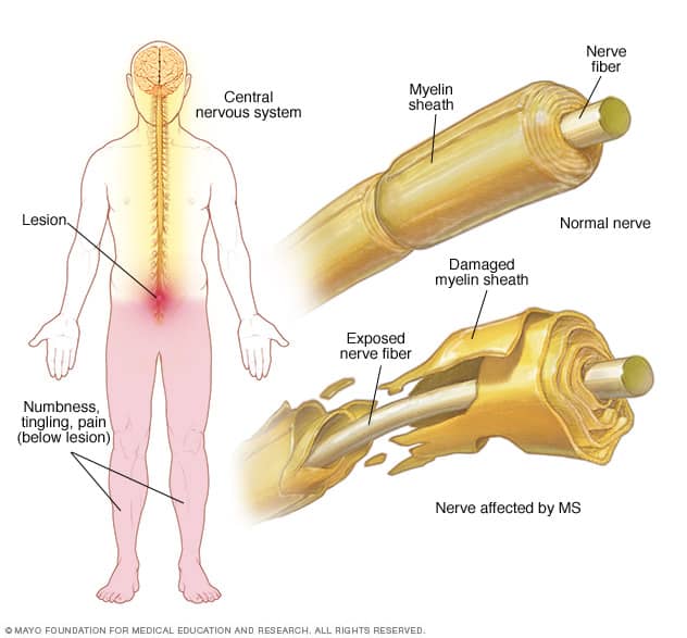 myelin sheath damage in MS