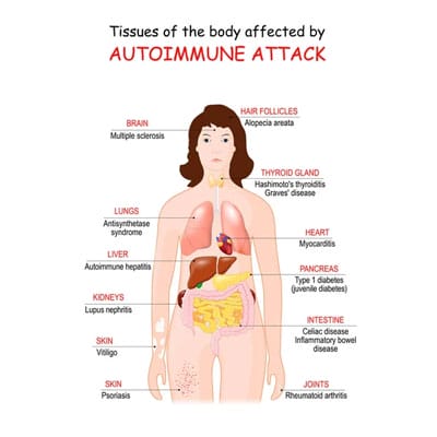 Illustration of a human body showing tissues affected by autoimmune diseases, including the brain, thyroid gland, lungs, pancreas, liver, kidneys, skin, and joints.