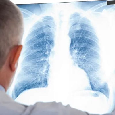 A person examines a chest X-ray image of lungs on a lightbox.