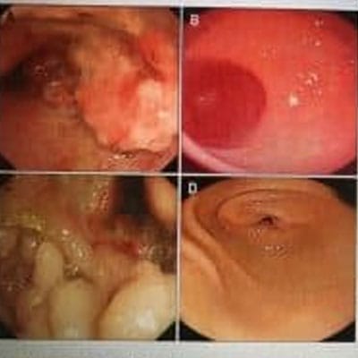 Four endoscopic images labeled A to D, showing different views of the gastrointestinal lining, with varying textures and colors, ranging from red and inflamed to smoother surfaces.